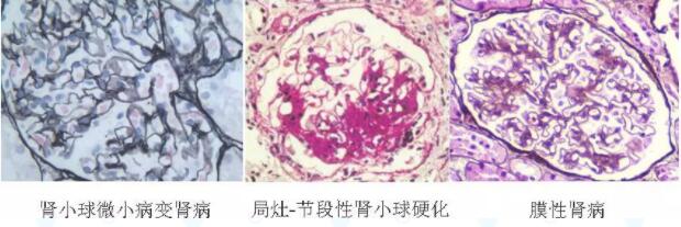 肾病综合征患者要做肾穿刺吗为你解读肾病综合征