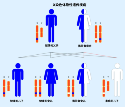 杜氏肌肉萎縮