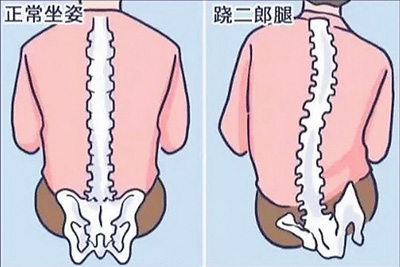 蹺二郎腿導致脊柱不正常彎曲。
