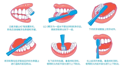 图为改良Bass法示意图。   北京口腔医院供图