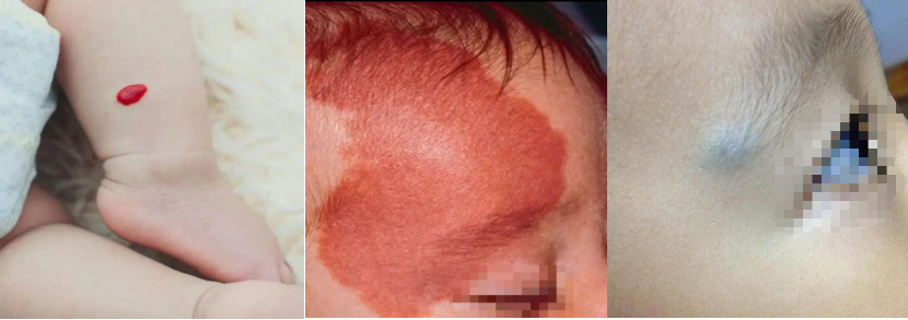 圖：嬰幼兒血管瘤（左，隆起）、葡萄酒色斑（中，平坦）、靜脈畸形（右，藍青色）