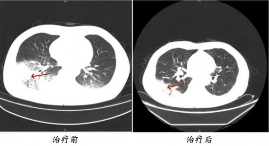 周先生治療前后的肺部CT影像